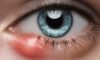 Eye Styes: Effective Home Remedies and Causes Explained